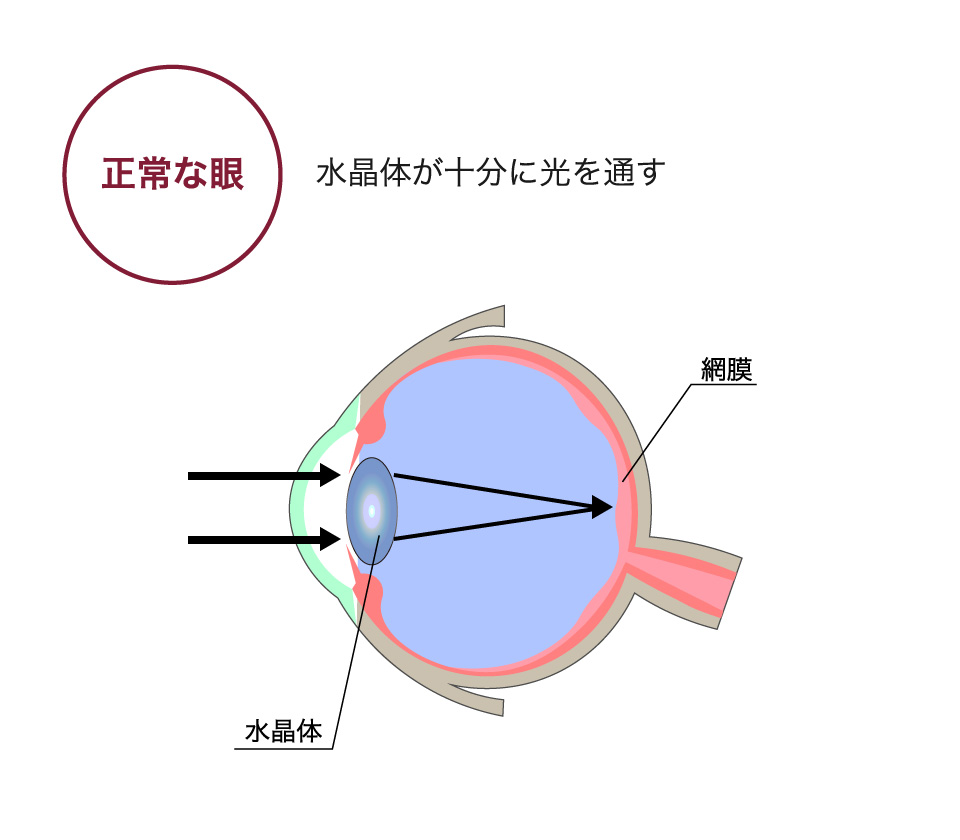 正常な眼→水晶体が十分に光を通す