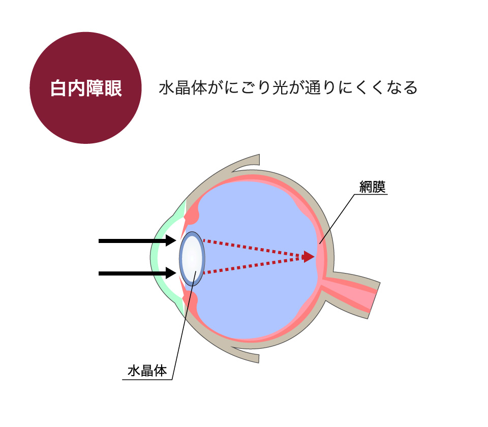 白内障眼→水晶体がにごり光が通りにくくなる