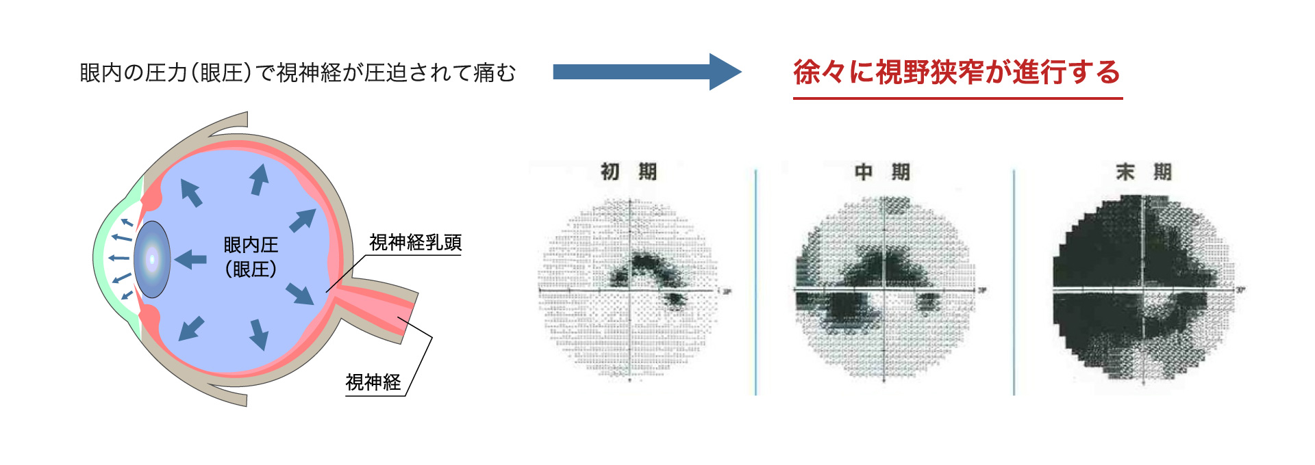 眼内の圧力（眼圧）で視神経が圧迫されて痛む→徐々に視野狭窄が進行する