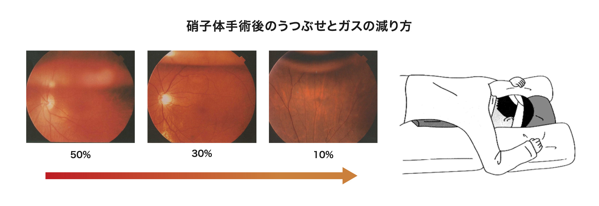 硝子体手術後のうつぶせとガスの減り方