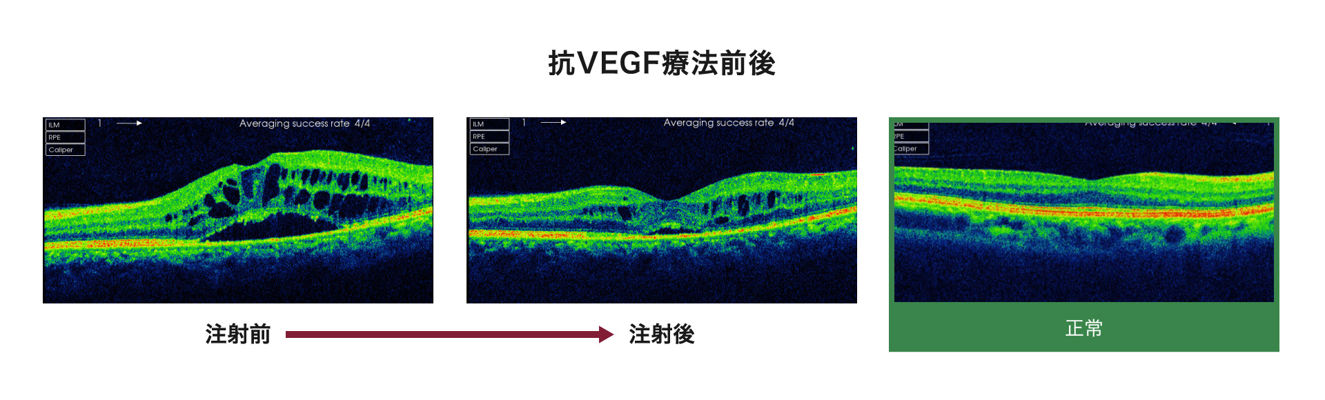 抗VEGF療法前後